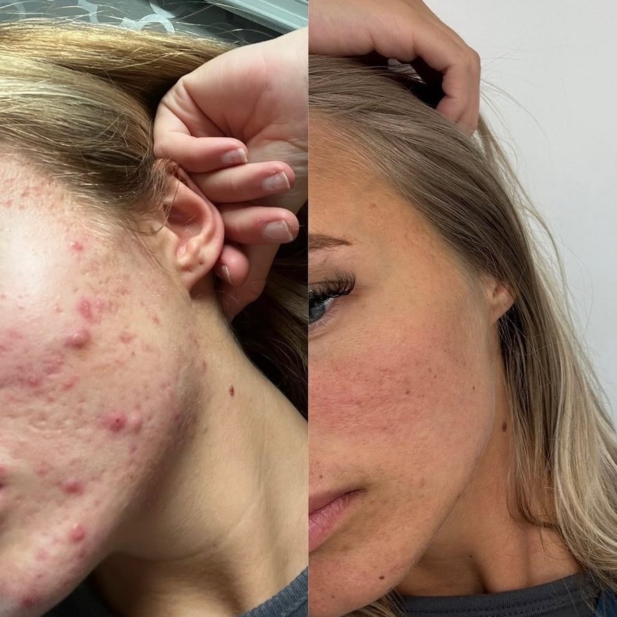 Georgia's own skin — her chin and jaw, before (active acne) above and after clear, following consistent microneedling and chemical peel treatment.