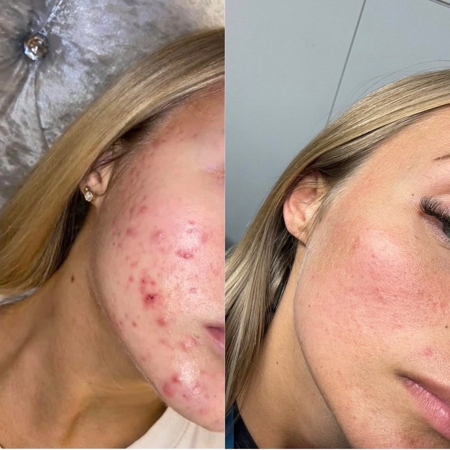 Georgia's own skin — her cheek and jaw in profile, before on the left and after on the right, following consistent microneedling and chemical peel treatment.