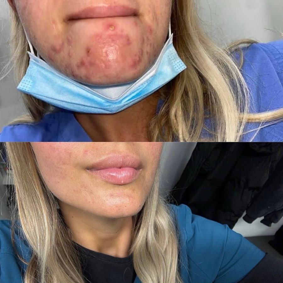 Georgia's own skin — her cheek, before on the left and after on the right, following consistent microneedling and chemical peel treatment.